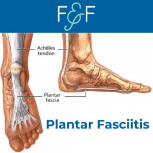 Bottom and side view of a foot with the plantar fascia labeled, showing the connective tissue running from the heel to the toes. Featured by Fit and Function Therapy Solutions.