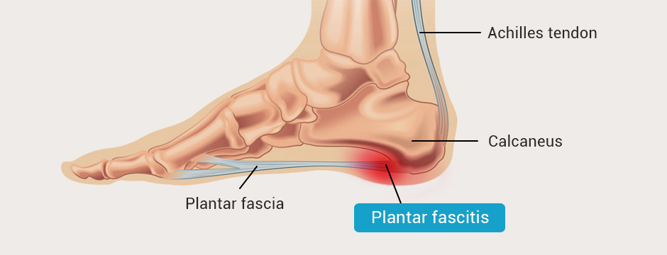 Diagram of a foot showing the connection between the plantar fascia, Achilles tendon, and calcaneus, with labels indicating where plantar fasciitis pain is typically felt.